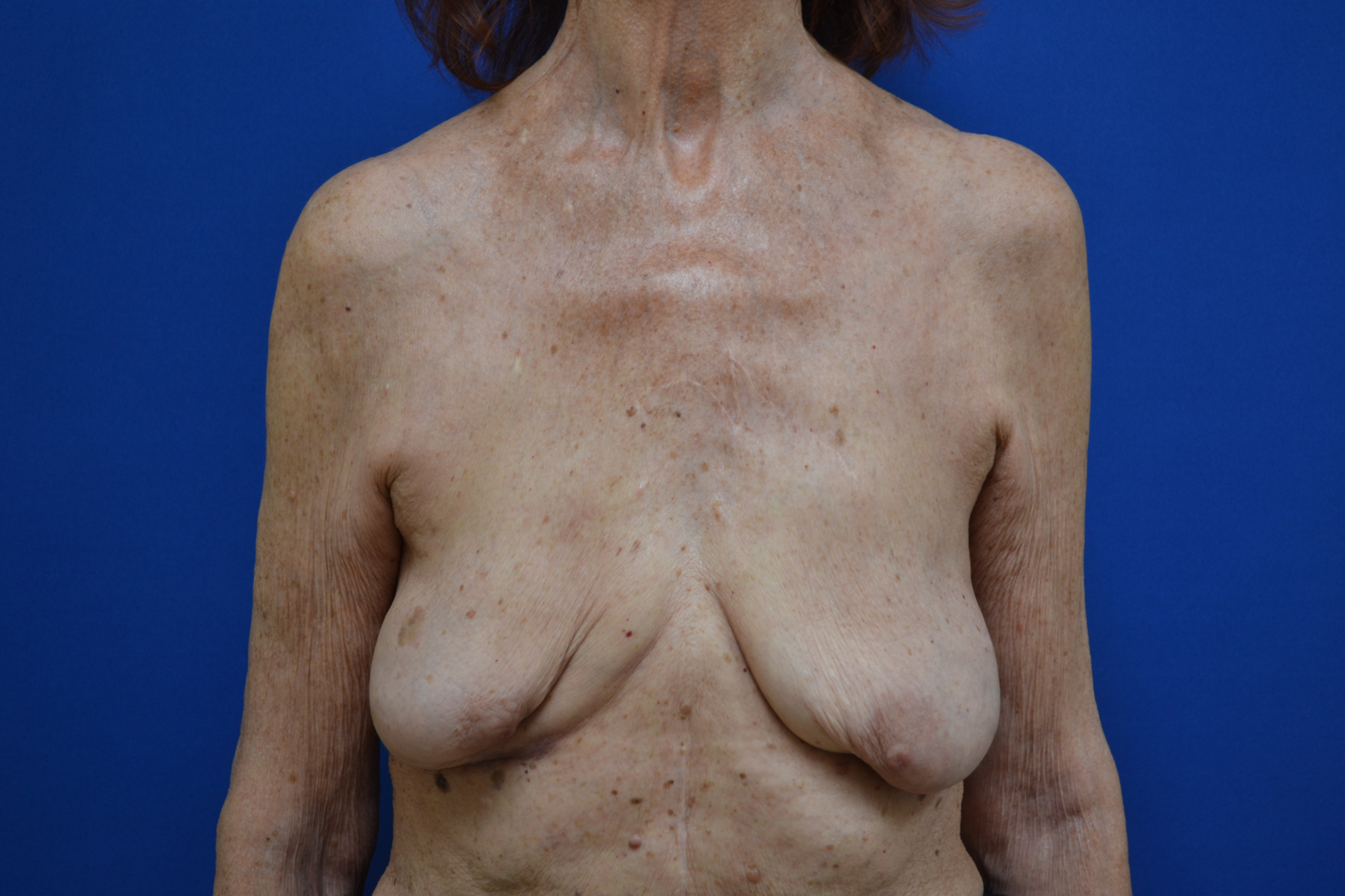 Breast Implant Removal Before and After | Brzowski Plastic Surgery