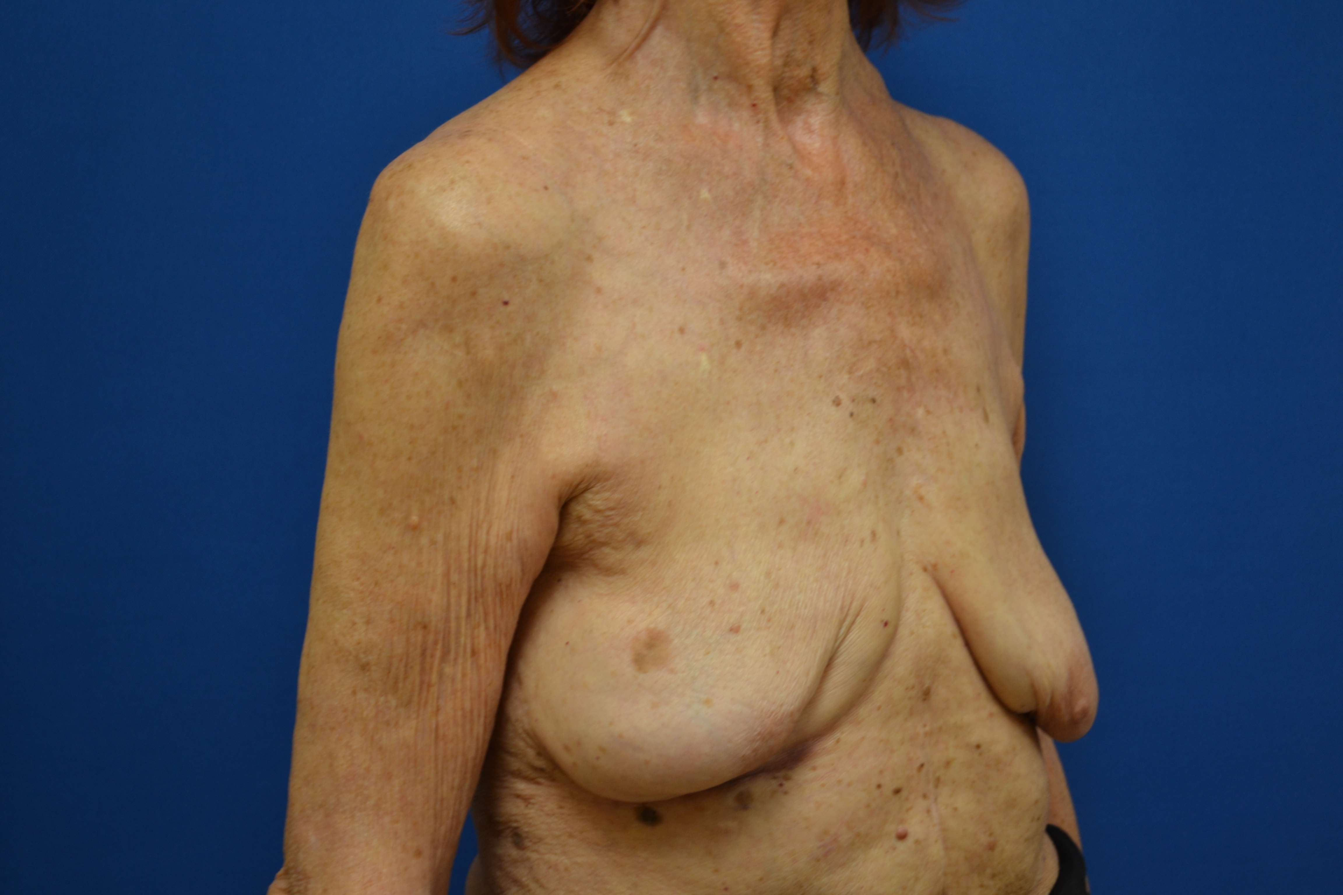 Breast Implant Removal Before and After | Brzowski Plastic Surgery