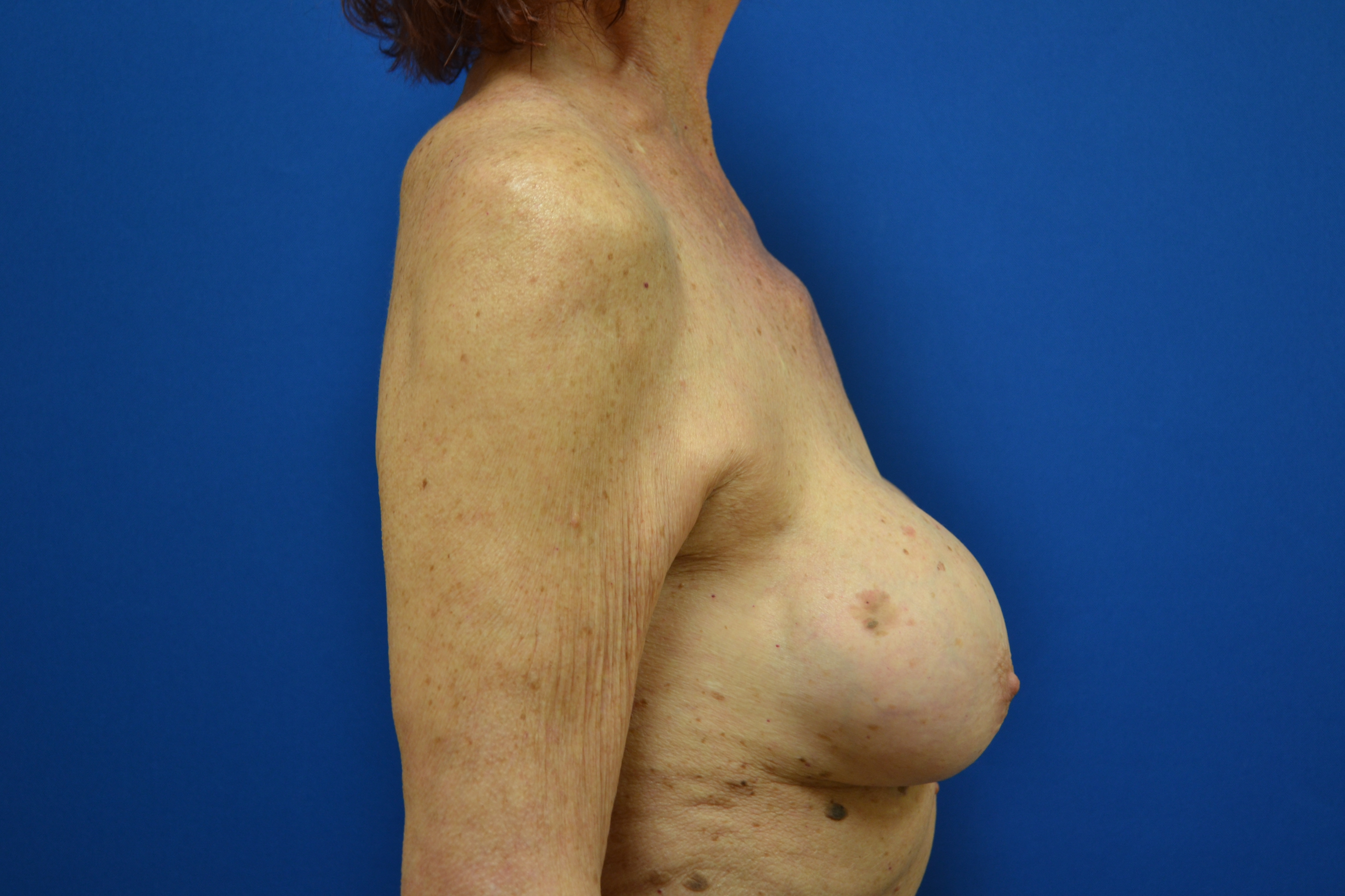 Breast Implant Removal Before and After | Brzowski Plastic Surgery