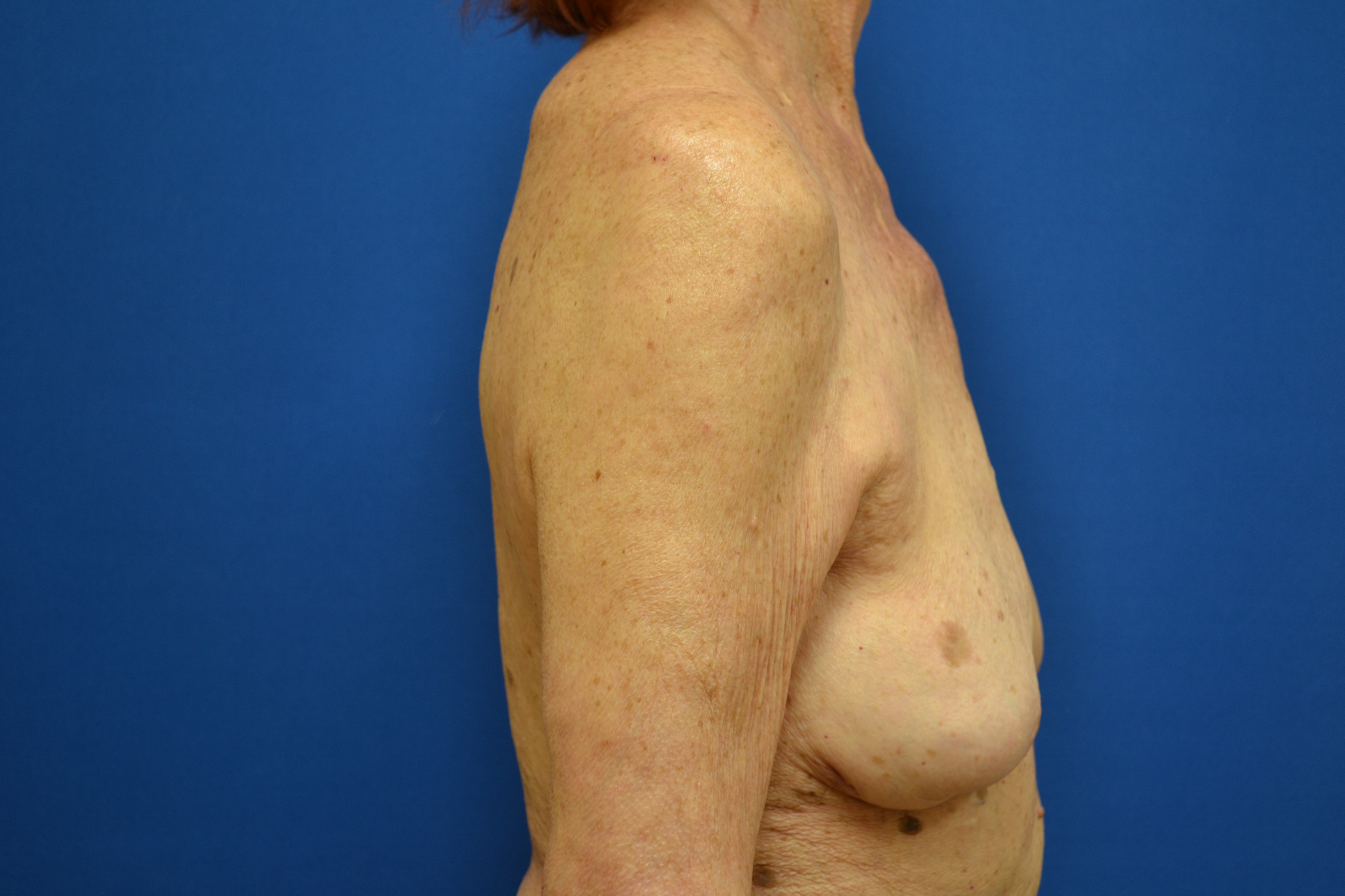 Breast Implant Removal Before and After | Brzowski Plastic Surgery