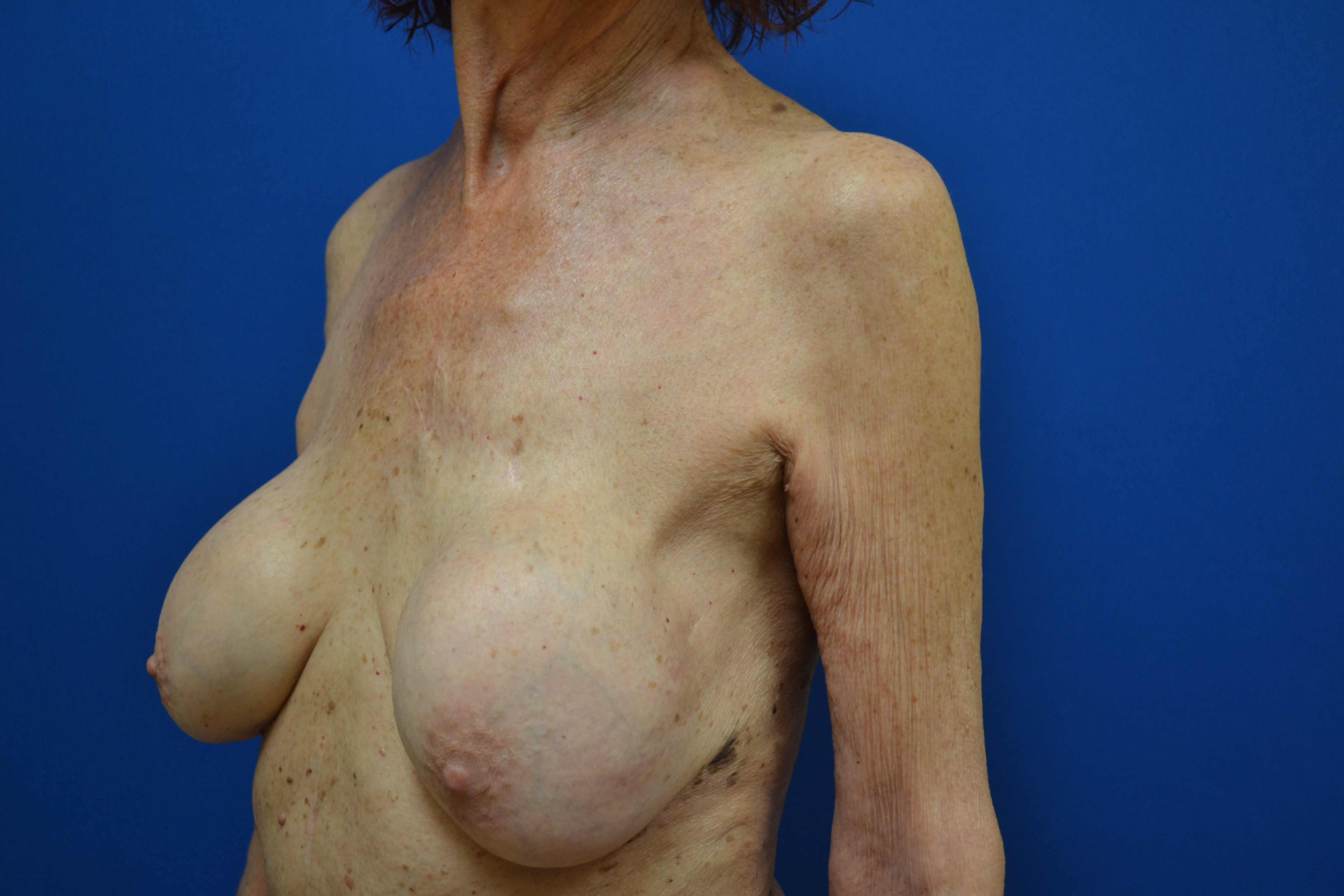 Breast Implant Removal Before and After | Brzowski Plastic Surgery