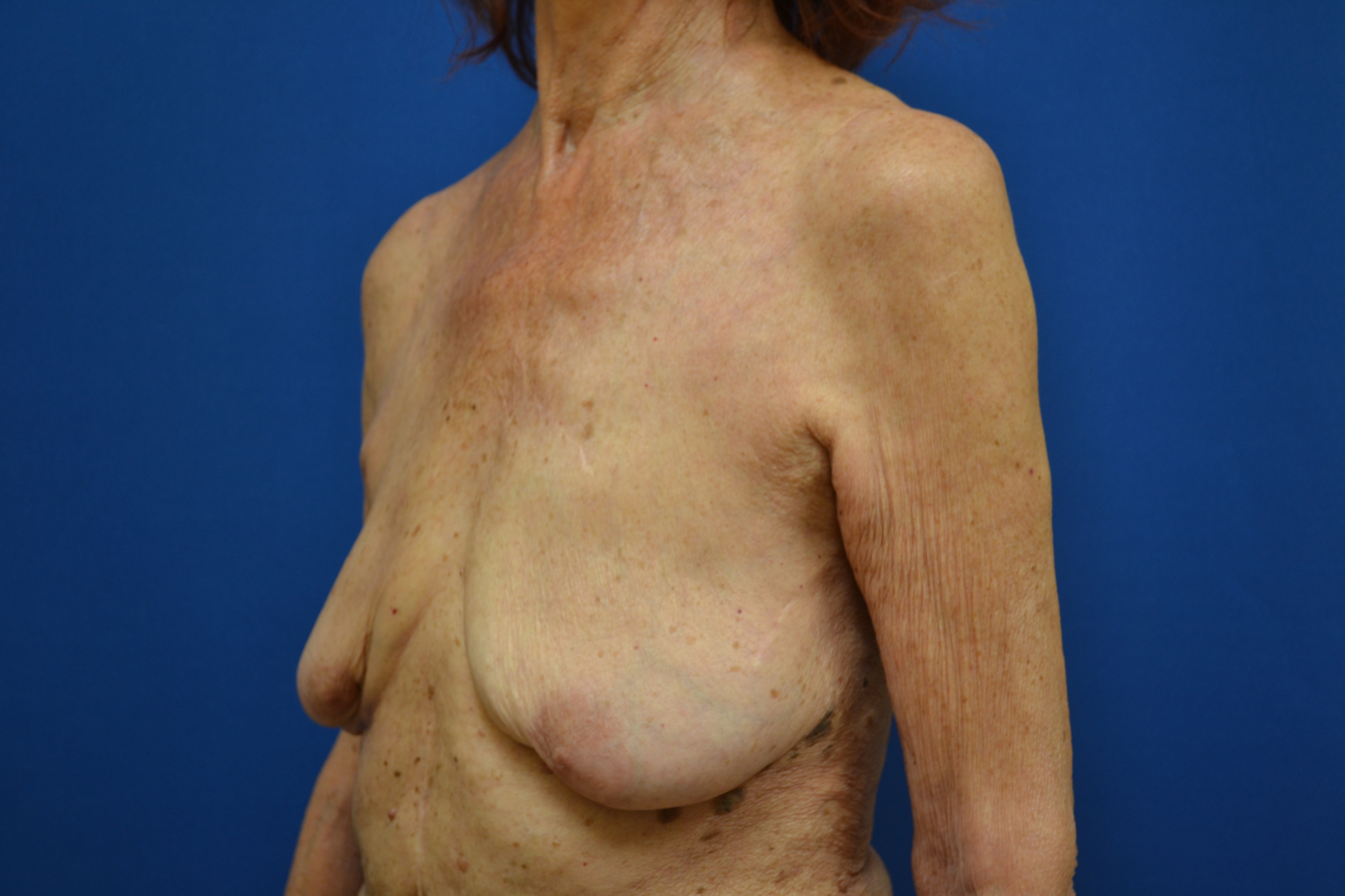 Breast Implant Removal Before and After | Brzowski Plastic Surgery