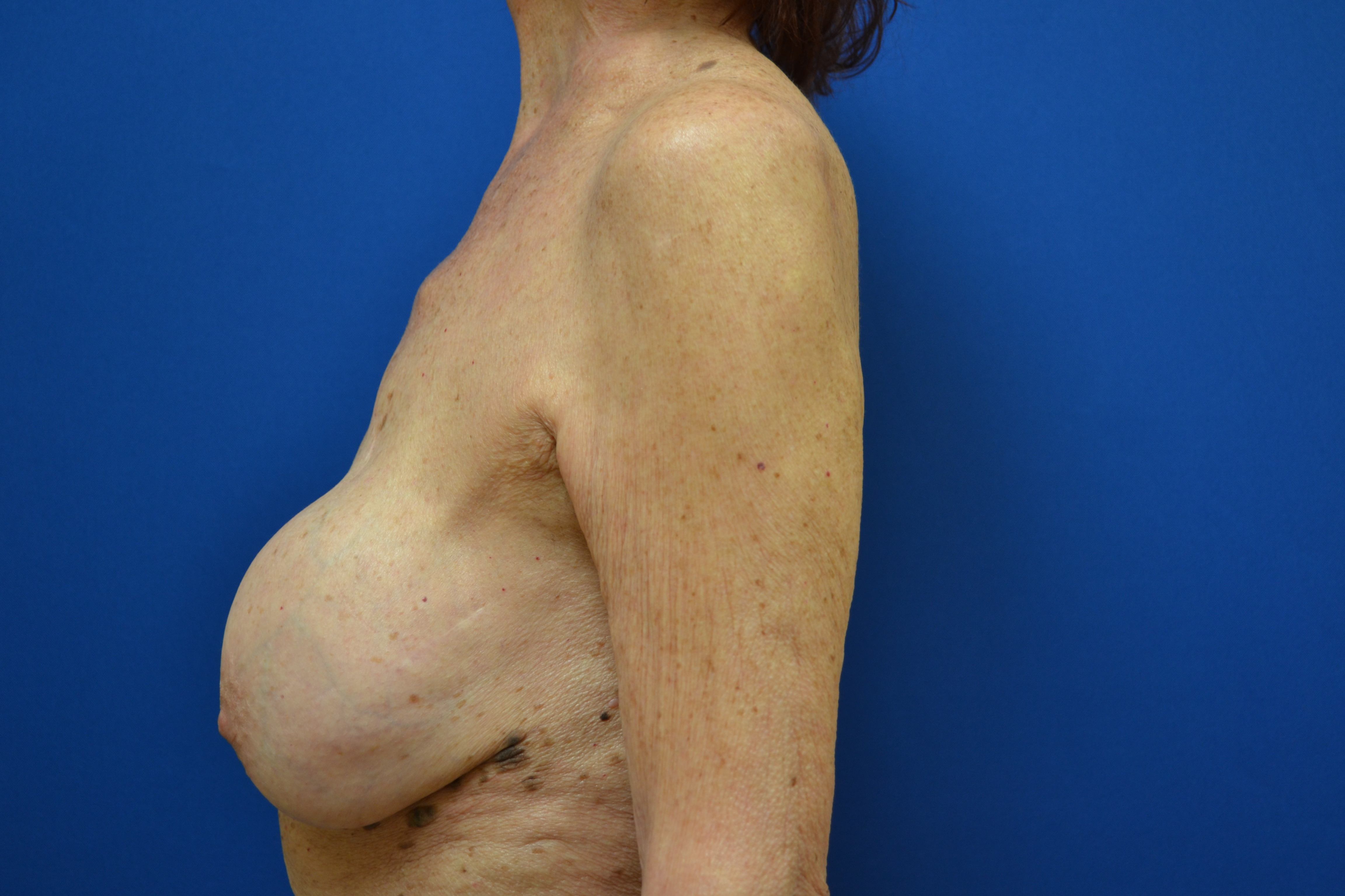 Breast Implant Removal Before and After | Brzowski Plastic Surgery