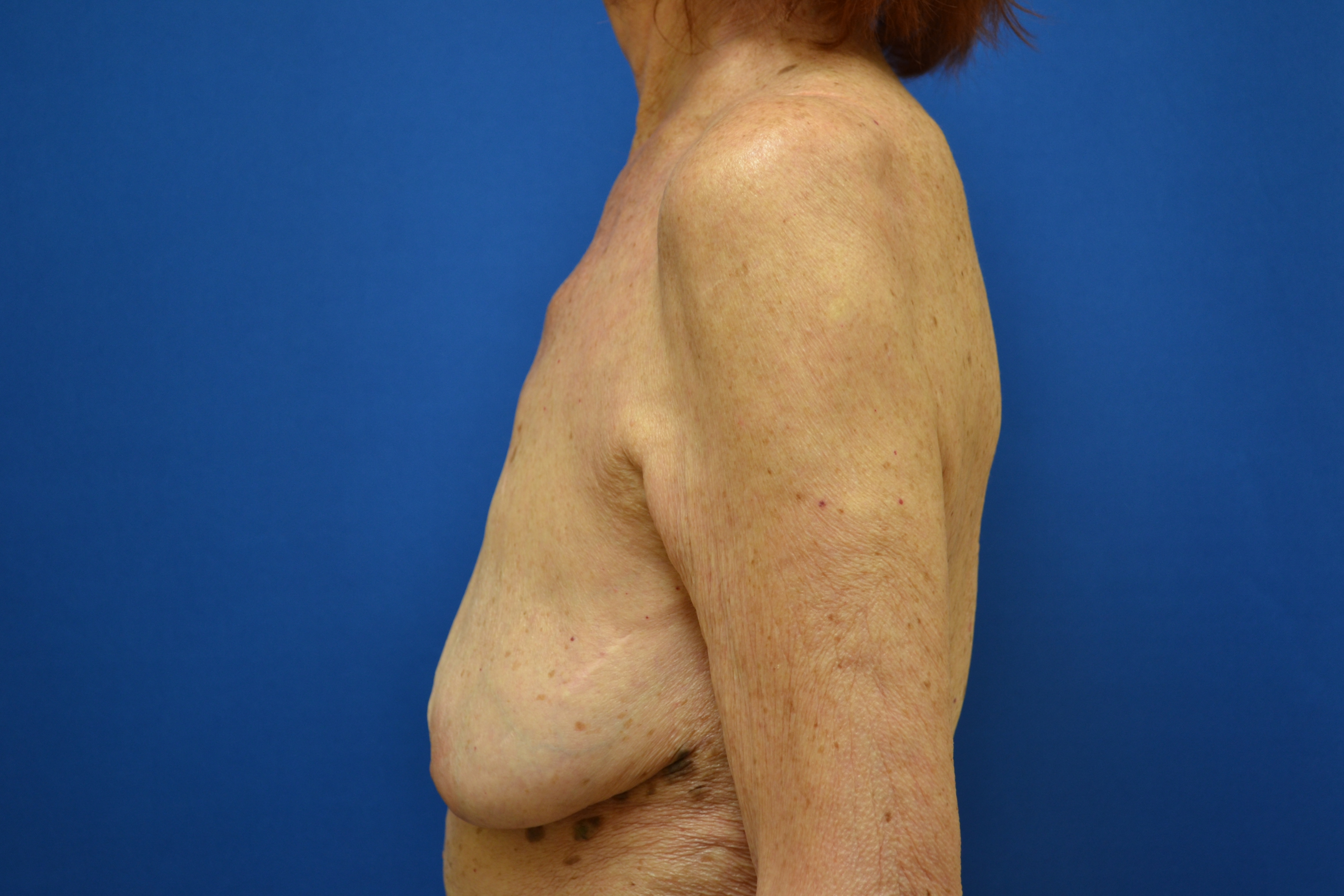 Breast Implant Removal Before and After | Brzowski Plastic Surgery