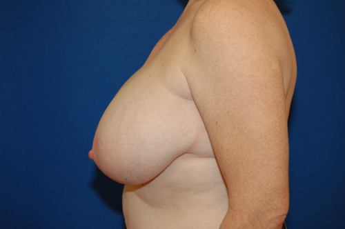 Breast Reduction Before and After | Brzowski Plastic Surgery