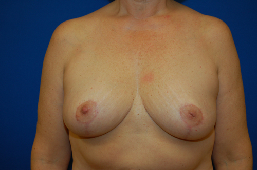 Breast Reduction Before and After | Brzowski Plastic Surgery