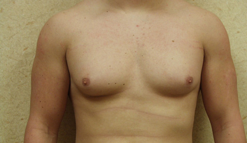 Gynecomastia Before and After | Brzowski Plastic Surgery