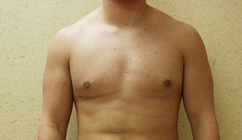 Gynecomastia Before and After | Brzowski Plastic Surgery