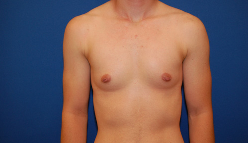 Gynecomastia Before and After | Brzowski Plastic Surgery