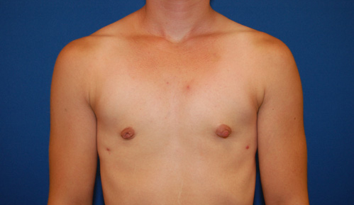 Gynecomastia Before and After | Brzowski Plastic Surgery