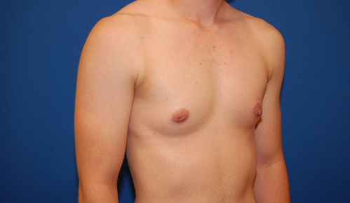 Gynecomastia Before and After | Brzowski Plastic Surgery