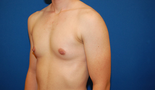 Gynecomastia Before and After | Brzowski Plastic Surgery