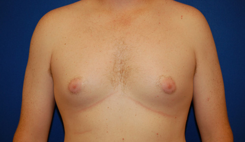 Gynecomastia Before and After | Brzowski Plastic Surgery