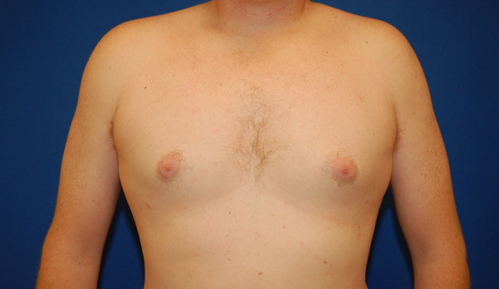 Gynecomastia Before and After | Brzowski Plastic Surgery