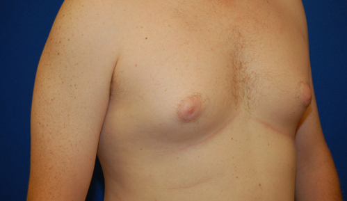 Gynecomastia Before and After | Brzowski Plastic Surgery