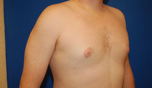 Gynecomastia Before and After | Brzowski Plastic Surgery