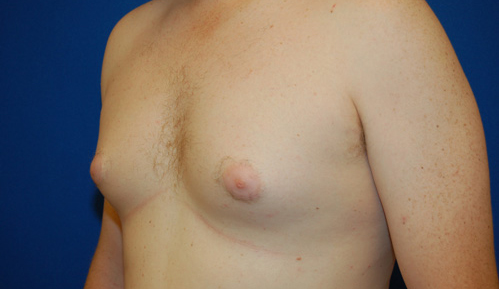 Gynecomastia Before and After | Brzowski Plastic Surgery