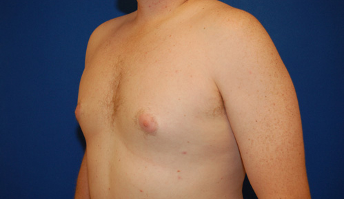 Gynecomastia Before and After | Brzowski Plastic Surgery