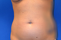 Liposuction Before and After | Brzowski Plastic Surgery