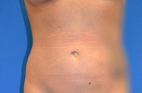 Liposuction Before and After | Brzowski Plastic Surgery