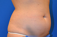 Liposuction Before and After | Brzowski Plastic Surgery