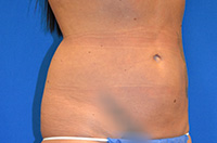 Liposuction Before and After | Brzowski Plastic Surgery