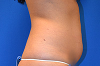 Liposuction Before and After | Brzowski Plastic Surgery