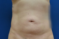 Liposuction Before and After | Brzowski Plastic Surgery