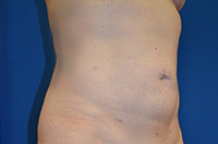 Liposuction Before and After | Brzowski Plastic Surgery