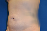 Liposuction Before and After | Brzowski Plastic Surgery